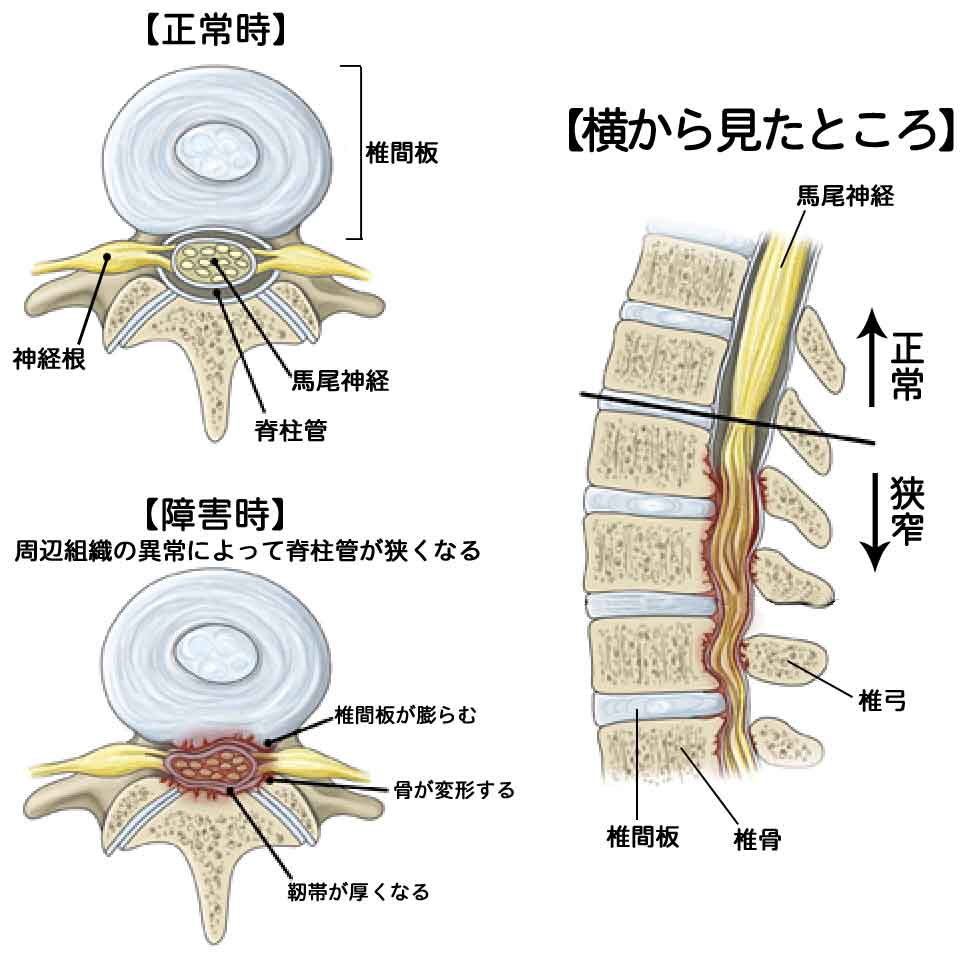 腰痛の原因となる 腰部 脊柱管狭窄症 とは 特徴 症状 治療