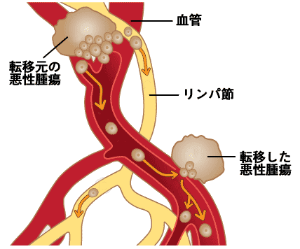 腰痛の原因となる 脊髄腫瘍 脊椎腫瘍 とは 特徴 症状 治療